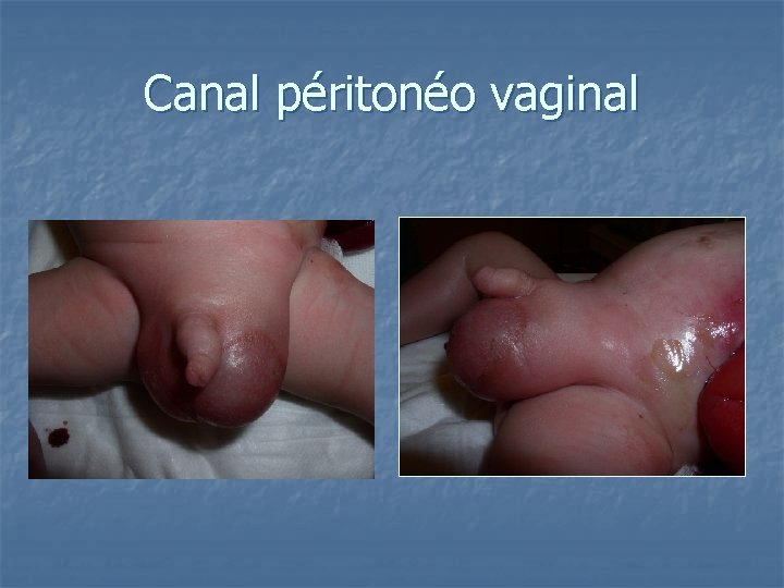 Canal péritonéo vaginal 