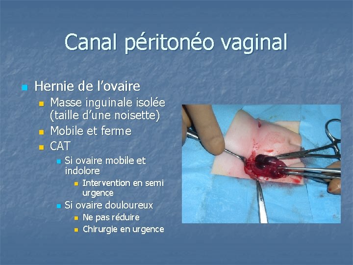 Canal péritonéo vaginal n Hernie de l’ovaire n n n Masse inguinale isolée (taille