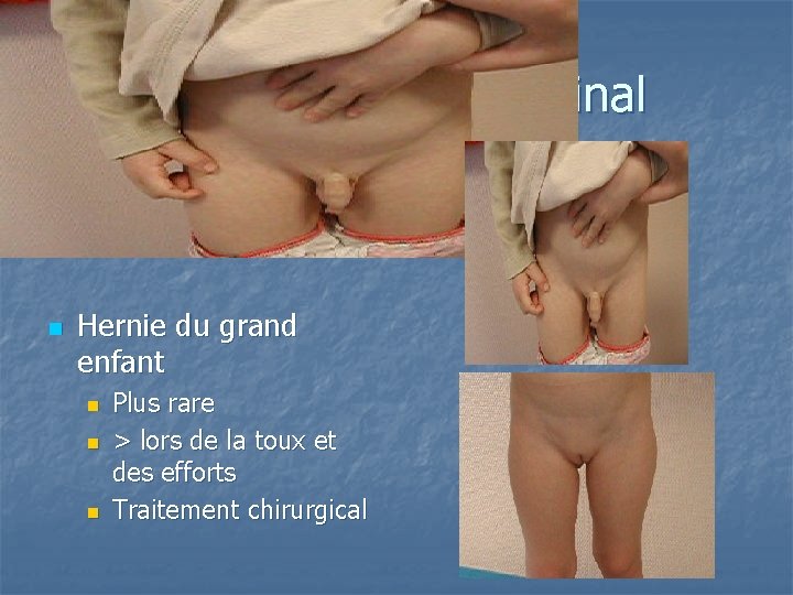 Canal péritonéo vaginal n Hernie du grand enfant n n n Plus rare >