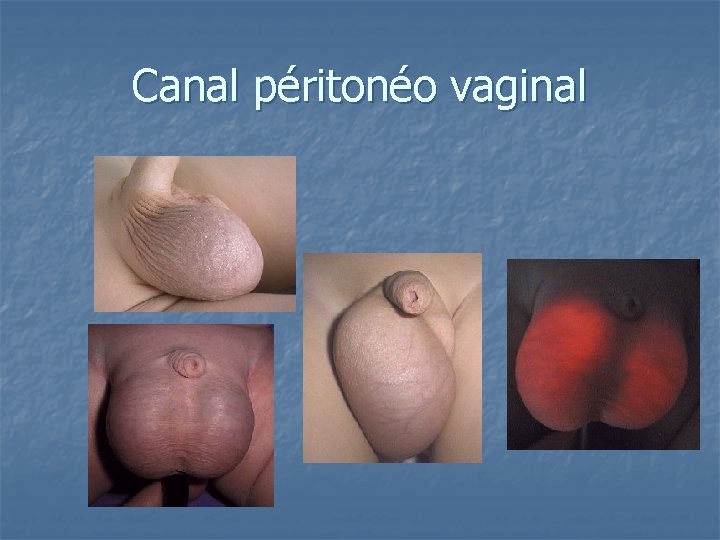 Canal péritonéo vaginal 