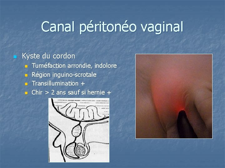 Canal péritonéo vaginal n Kyste du cordon n n Tuméfaction arrondie, indolore Région inguino-scrotale