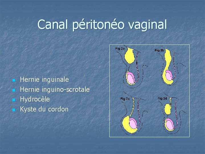 Canal péritonéo vaginal n n Hernie inguinale Hernie inguino-scrotale Hydrocèle Kyste du cordon 