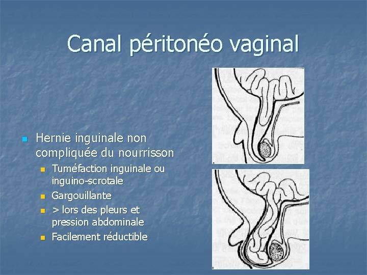 Canal péritonéo vaginal n Hernie inguinale non compliquée du nourrisson n n Tuméfaction inguinale