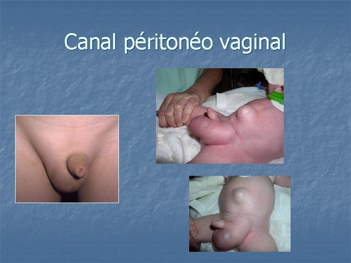 Canal péritonéo vaginal 