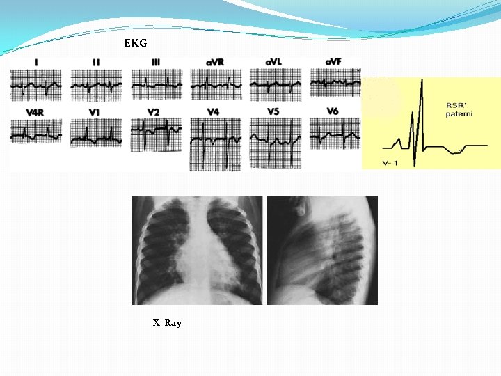 EKG X_Ray 