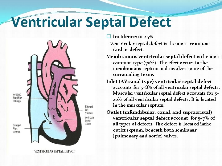 Ventricular Septal Defect � İncidence: 20 -25% Ventricular septal defect is the most common