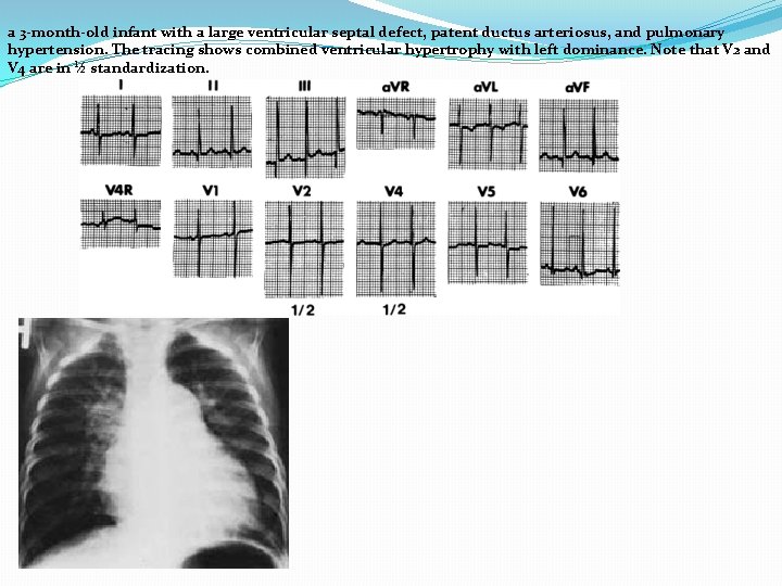 a 3 -month-old infant with a large ventricular septal defect, patent ductus arteriosus, and