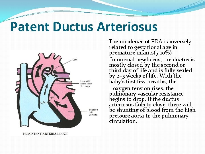 Patent Ductus Arteriosus The incidence of PDA is inversely related to gestational age in
