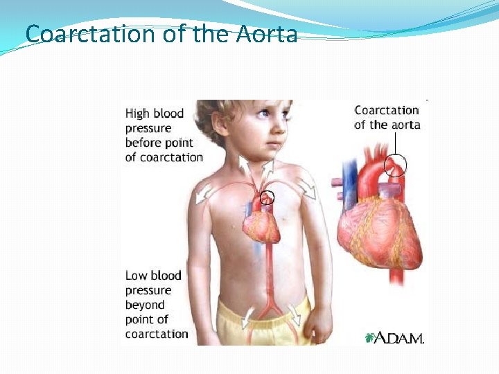 Coarctation of the Aorta 