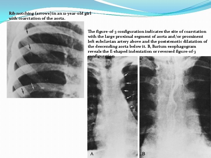 Rib notching (arrows) in an 11 -year-old girl with coarctation of the aorta. The