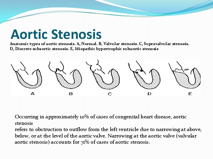 Aortic Stenosis Anatomic types of aortic stenosis. A, Normal. B, Valvular stenosis. C, Supravalvular