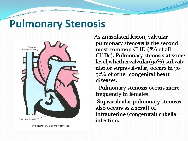 Pulmonary Stenosis As an isolated lesion, valvular pulmonary stenosis is the second most common