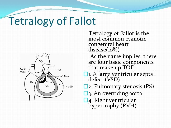 Tetralogy of Fallot is the most common cyanotic congenital heart disease(10%) As the name