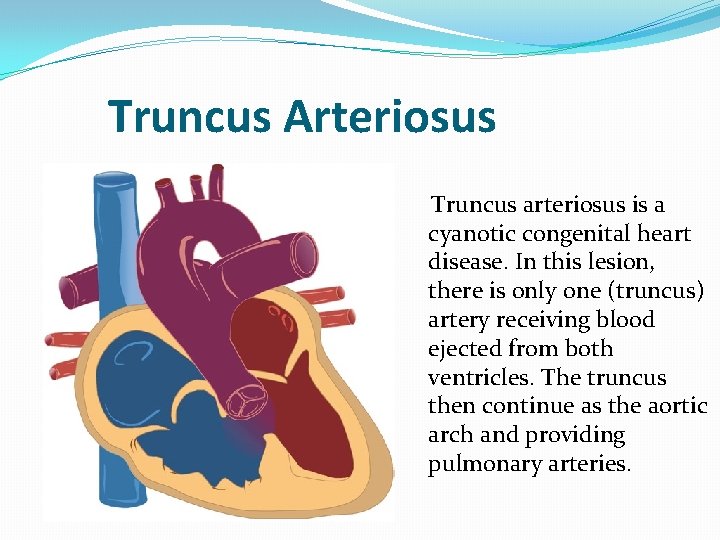 Truncus Arteriosus Truncus arteriosus is a cyanotic congenital heart disease. In this lesion, there