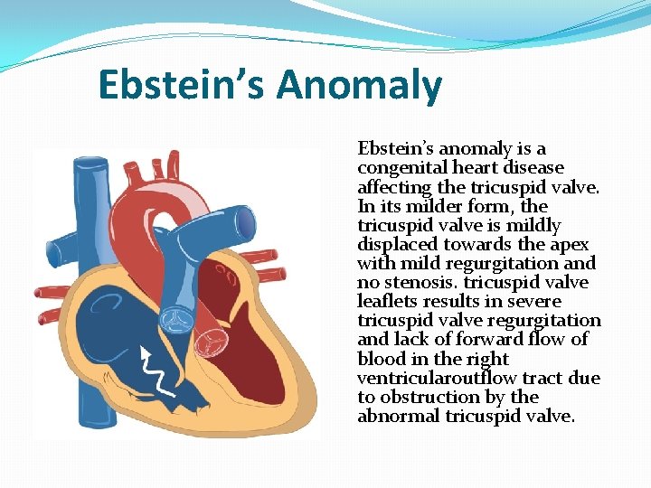 Ebstein’s Anomaly Ebstein’s anomaly is a congenital heart disease affecting the tricuspid valve. In