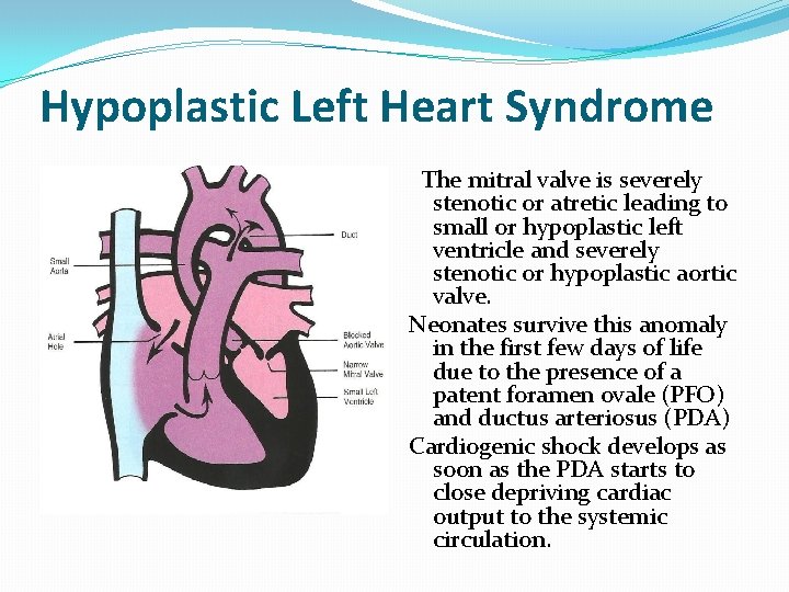 Hypoplastic Left Heart Syndrome The mitral valve is severely stenotic or atretic leading to