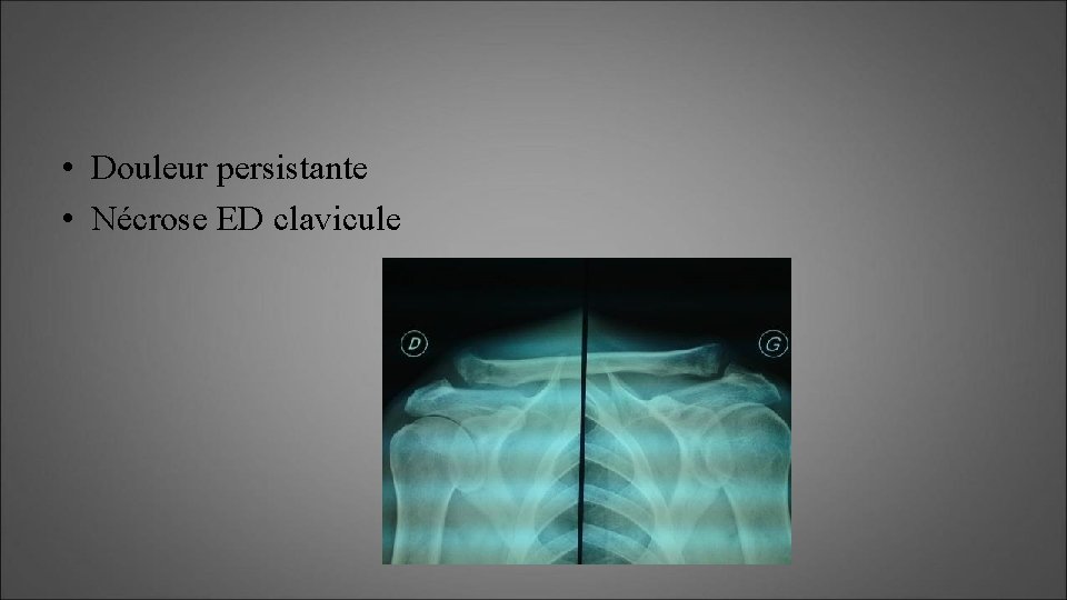  • Douleur persistante • Nécrose ED clavicule 