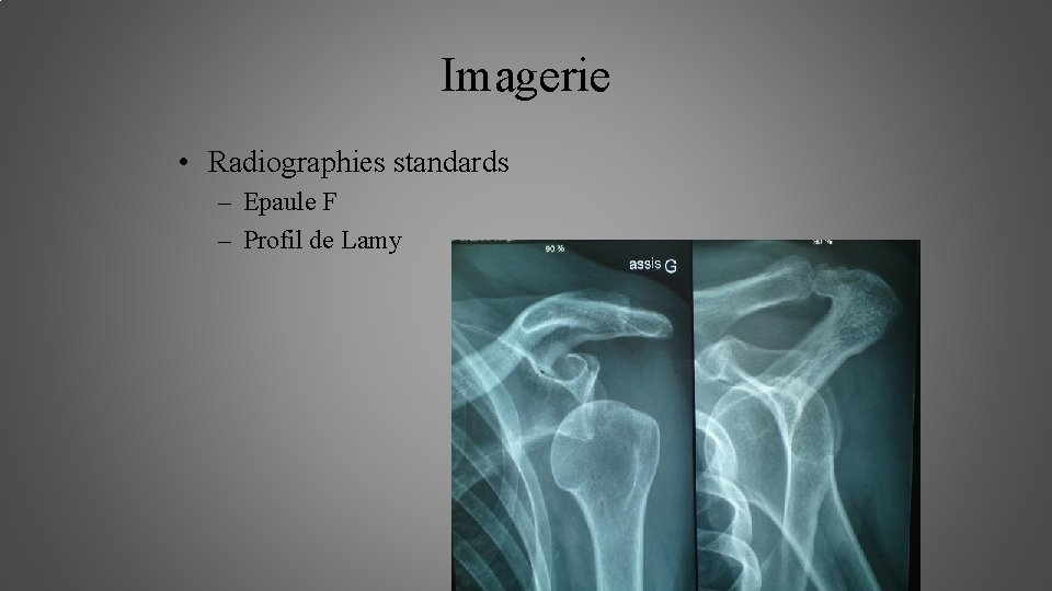 Imagerie • Radiographies standards – Epaule F – Profil de Lamy 