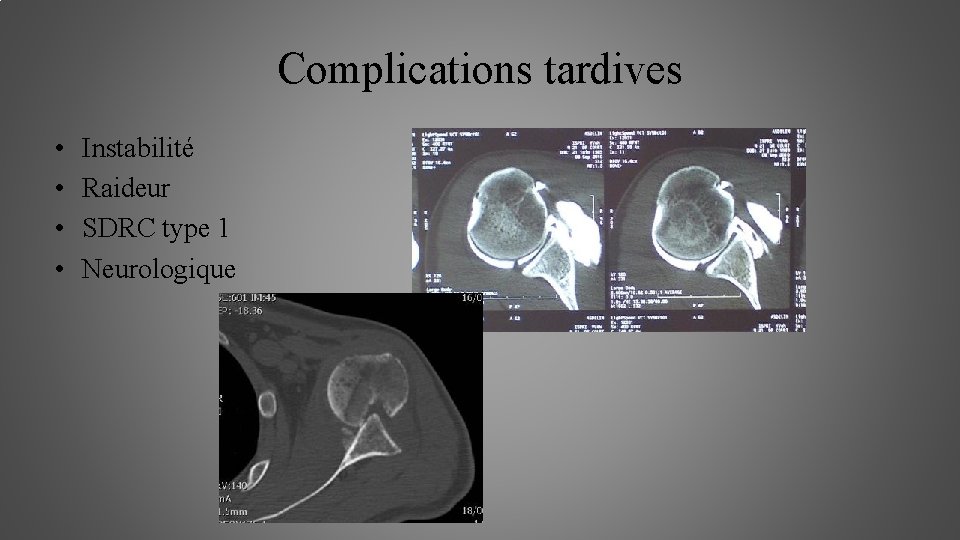 Complications tardives • • Instabilité Raideur SDRC type 1 Neurologique 