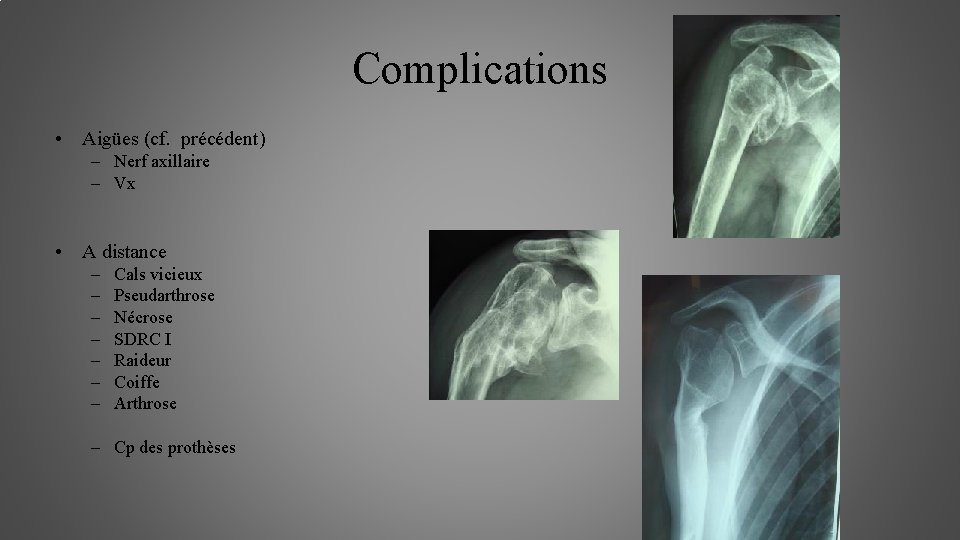 Complications • Aigües (cf. précédent) – Nerf axillaire – Vx • A distance –