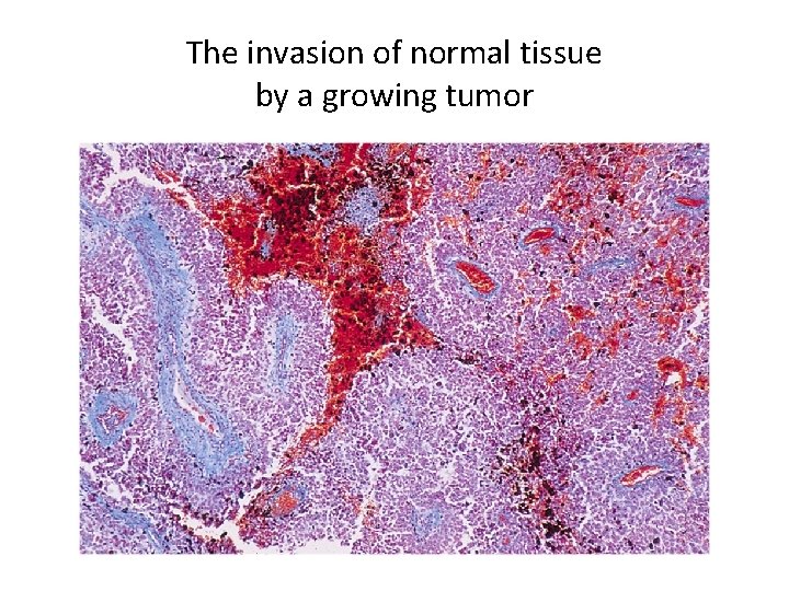 The invasion of normal tissue by a growing tumor 