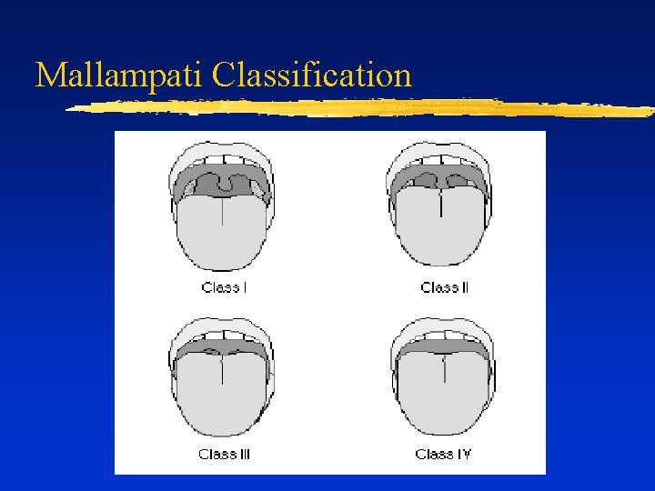 Mallampati Classification 