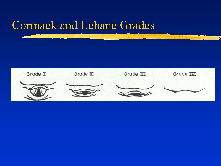 Cormack and Lehane Grades 