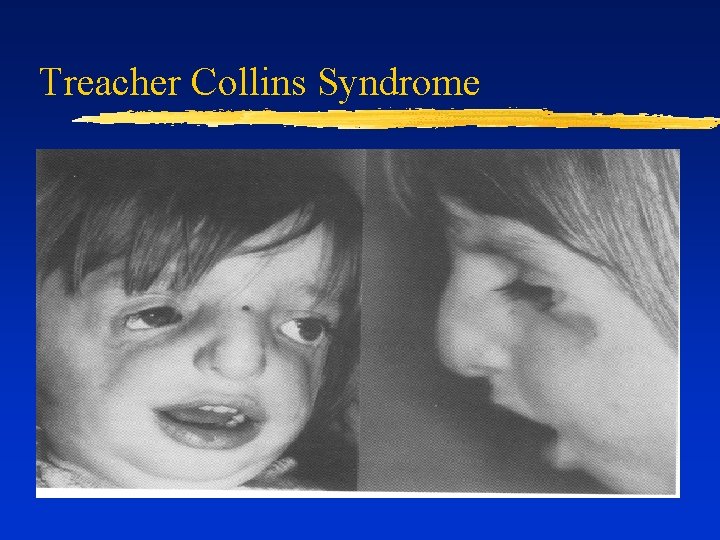 Treacher Collins Syndrome 