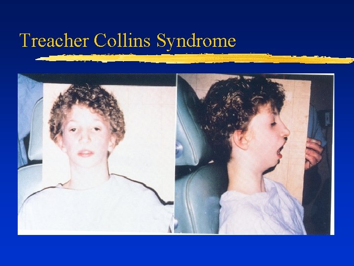 Treacher Collins Syndrome 