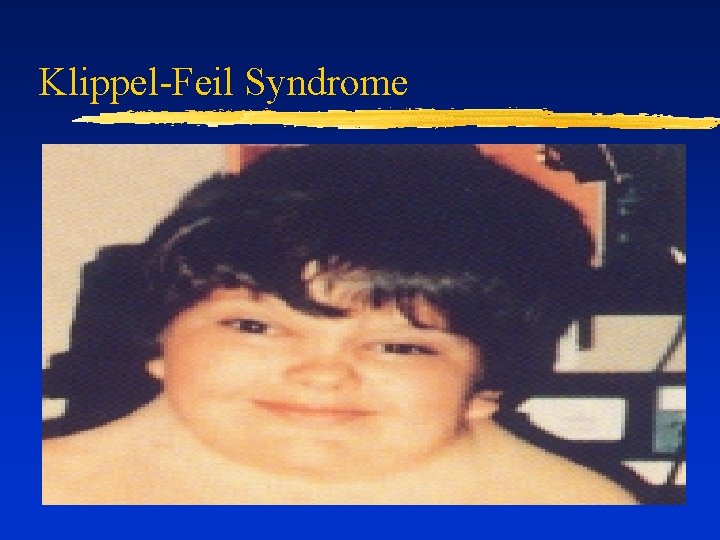 Klippel-Feil Syndrome 