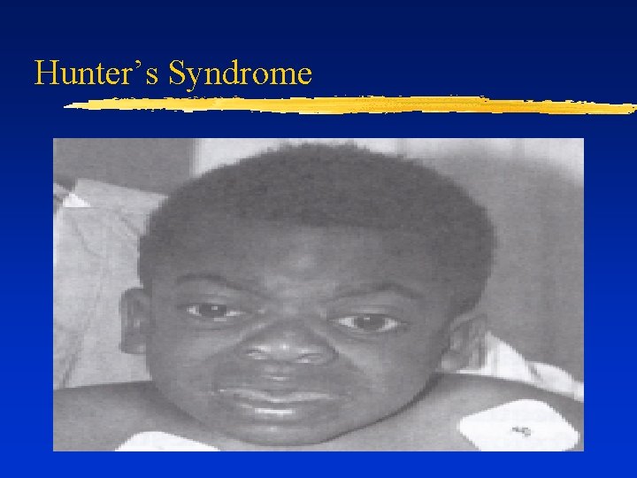 Hunter’s Syndrome 