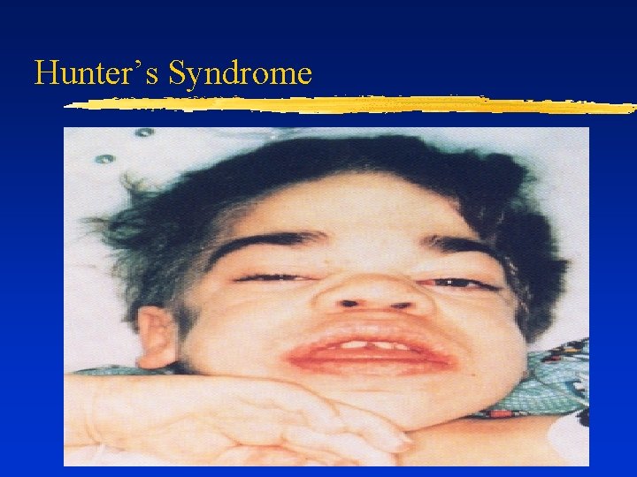 Hunter’s Syndrome 