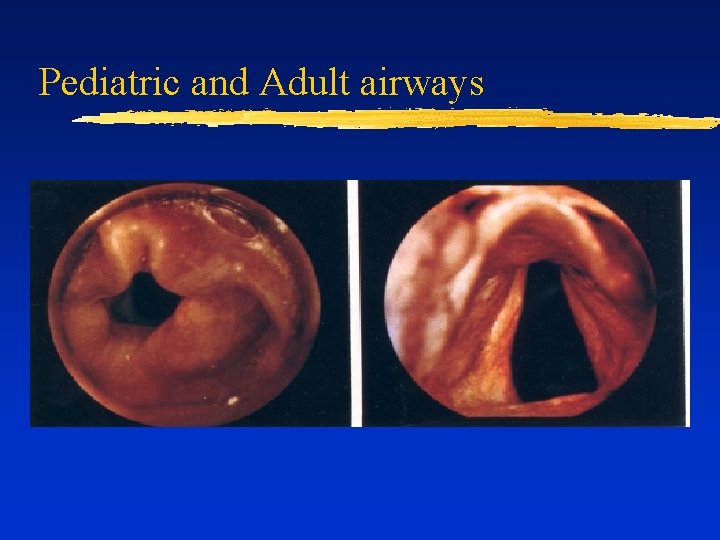 Pediatric and Adult airways 