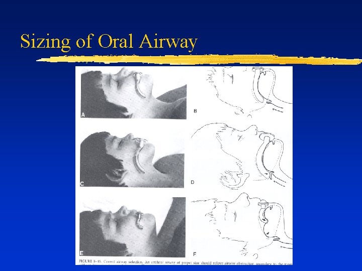 Sizing of Oral Airway 