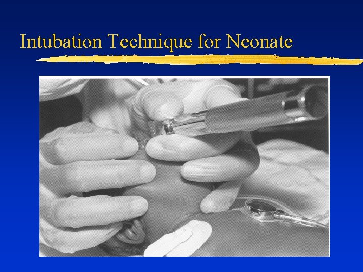 Intubation Technique for Neonate 