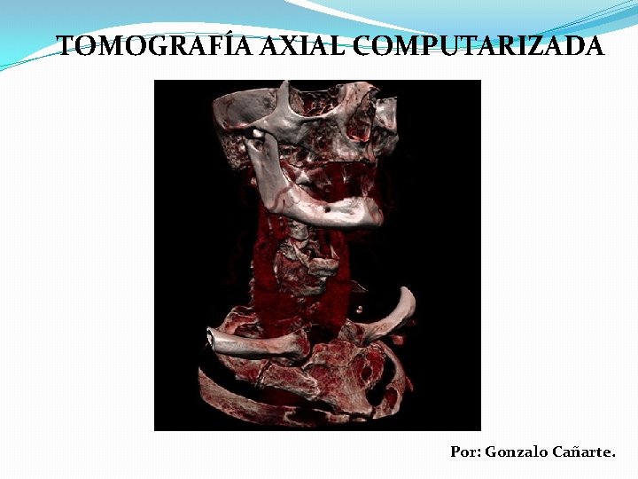 TOMOGRAFÍA AXIAL COMPUTARIZADA Por: Gonzalo Cañarte. 