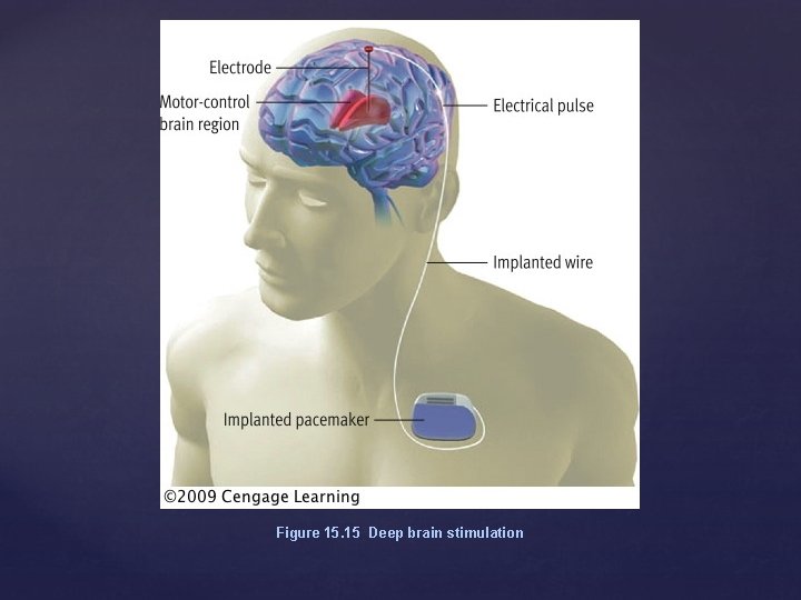 Figure 15. 15 Deep brain stimulation 