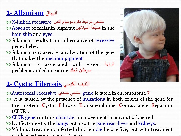 1 - Albinism ﺍﻟﺒﻬﺎﻕ X-linked recessive ﻣﺘﻨﺤﻲ ﻣﺮﺗﺒﻂ ﺑﻜﺮﻭﻣﻮﺳﻮﻡ ﺍﻛﺲ Absence of melanin pigment