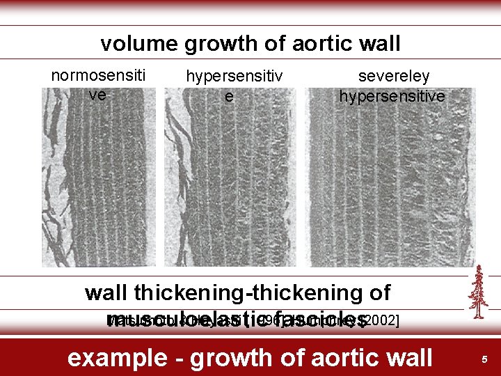 volume growth of aortic wall normosensiti ve hypersensitiv e severeley hypersensitive wall thickening-thickening of
