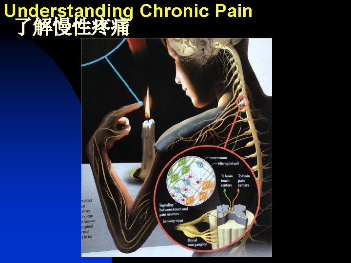 Understanding Chronic Pain 了解慢性疼痛 