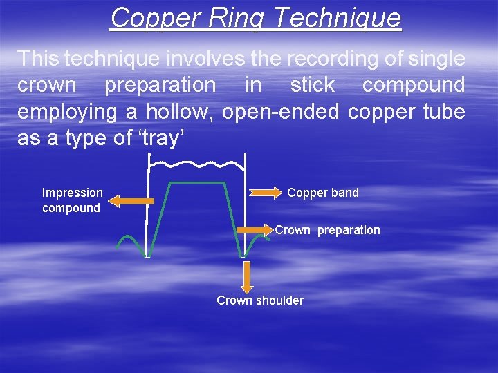 Copper Ring Technique This technique involves the recording of single crown preparation in stick