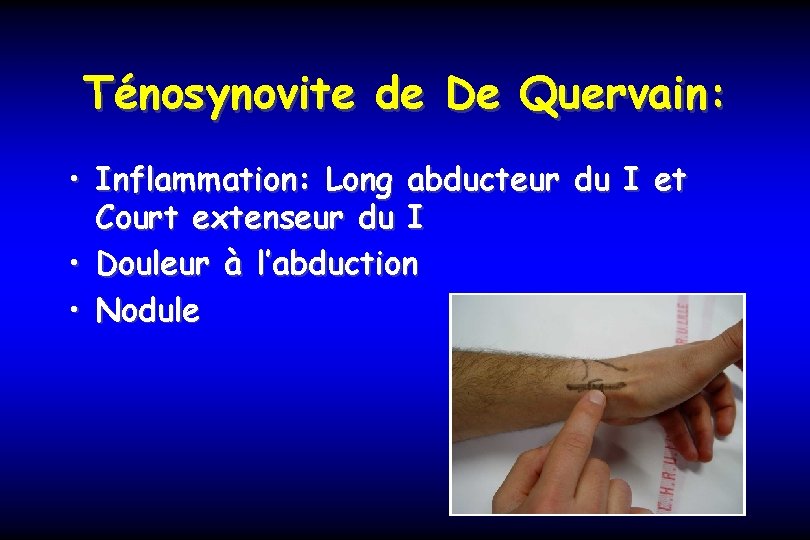 Ténosynovite de De Quervain: • Inflammation: Long abducteur du I et Court extenseur du