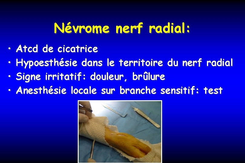 Névrome nerf radial: • • Atcd de cicatrice Hypoesthésie dans le territoire du nerf