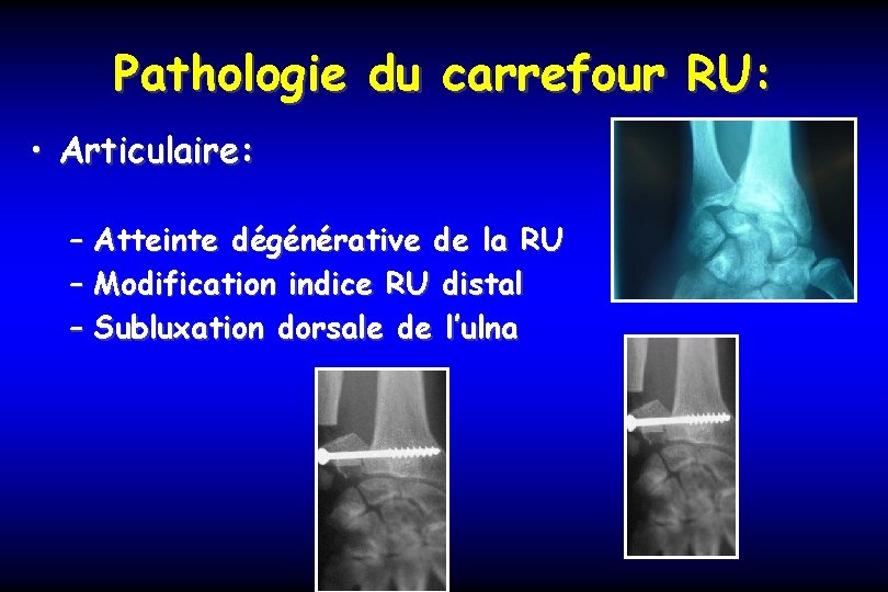 Pathologie du carrefour RU: • Articulaire: – Atteinte dégénérative de la RU – Modification
