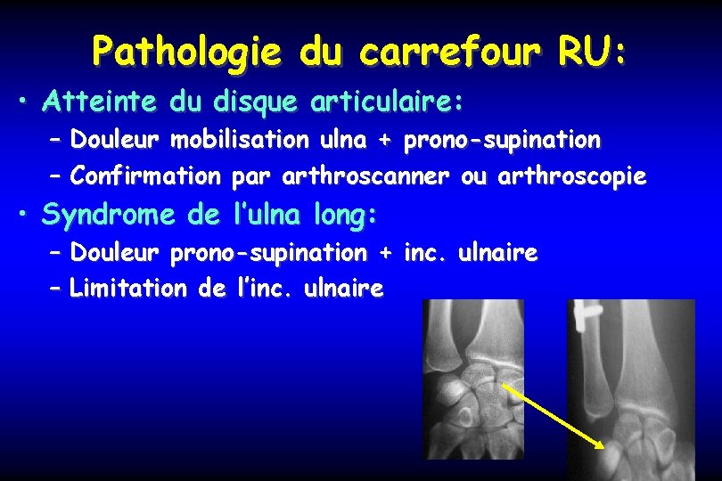 Pathologie du carrefour RU: • Atteinte du disque articulaire: – Douleur mobilisation ulna +