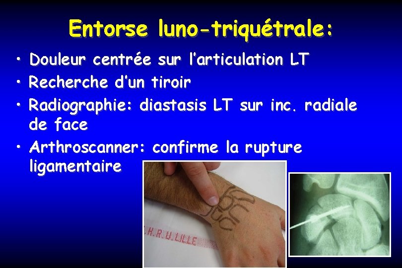 Entorse luno-triquétrale: • Douleur centrée sur l’articulation LT • Recherche d’un tiroir • Radiographie: