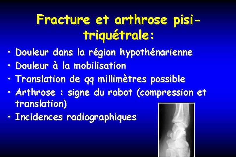 Fracture et arthrose pisitriquétrale: • • Douleur dans la région hypothénarienne Douleur à la