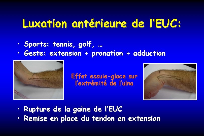 Luxation antérieure de l’EUC: • Sports: tennis, golf, … • Geste: extension + pronation
