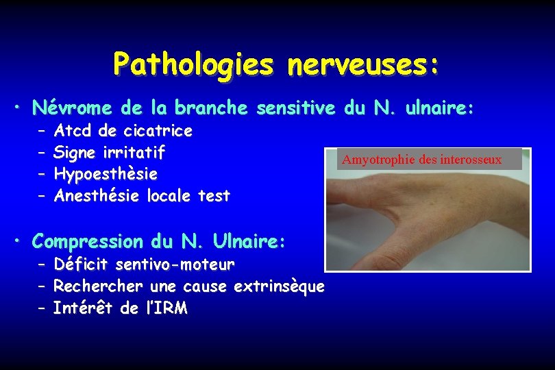 Pathologies nerveuses: • Névrome de la branche sensitive du N. ulnaire: – – Atcd