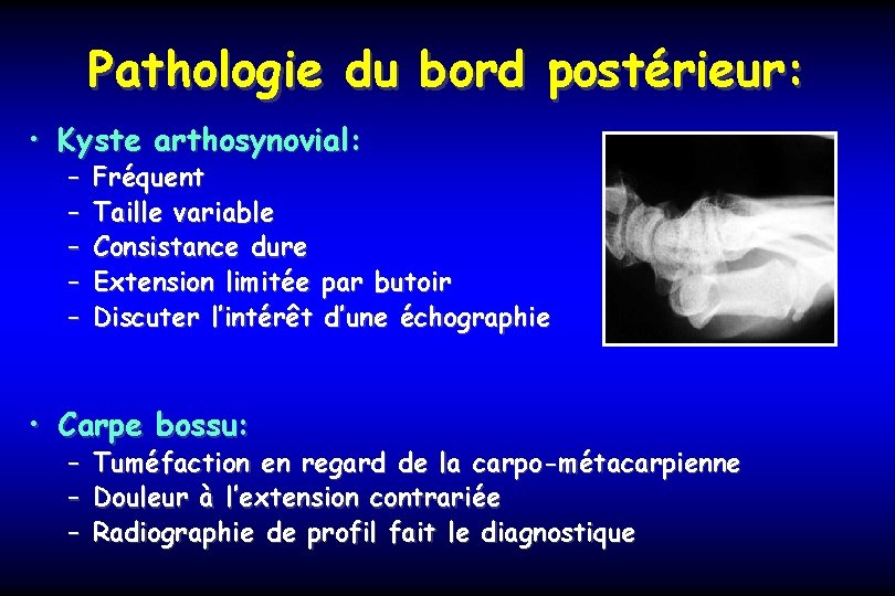 Pathologie du bord postérieur: • Kyste arthosynovial: – – – Fréquent Taille variable Consistance
